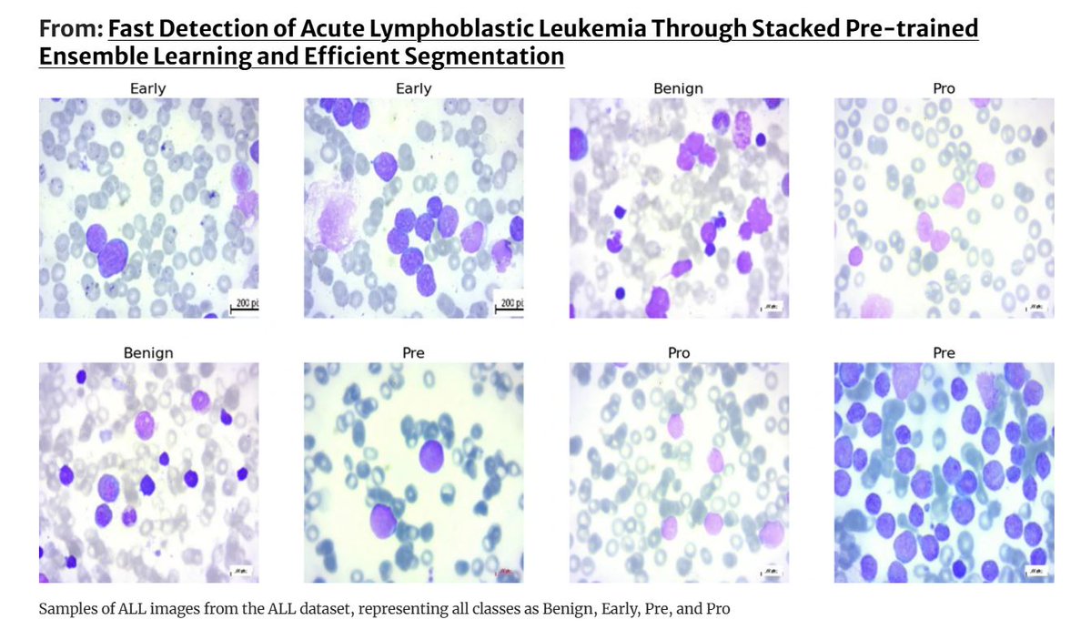 AJSE_SciEng's tweet image. ⚪️ 99.39% accuracy | 0.9963 F1: Stacked CNNs + FXGBoost = high-speed, explainable ALL diagnosis. Grad-CAM, ITP analysis, and Tukey HSD confirm clinical potential.
link.springer.com/article/10.100…
#AIHealth #LeukemiaDetection #MedicalImaging #EnsembleLearning