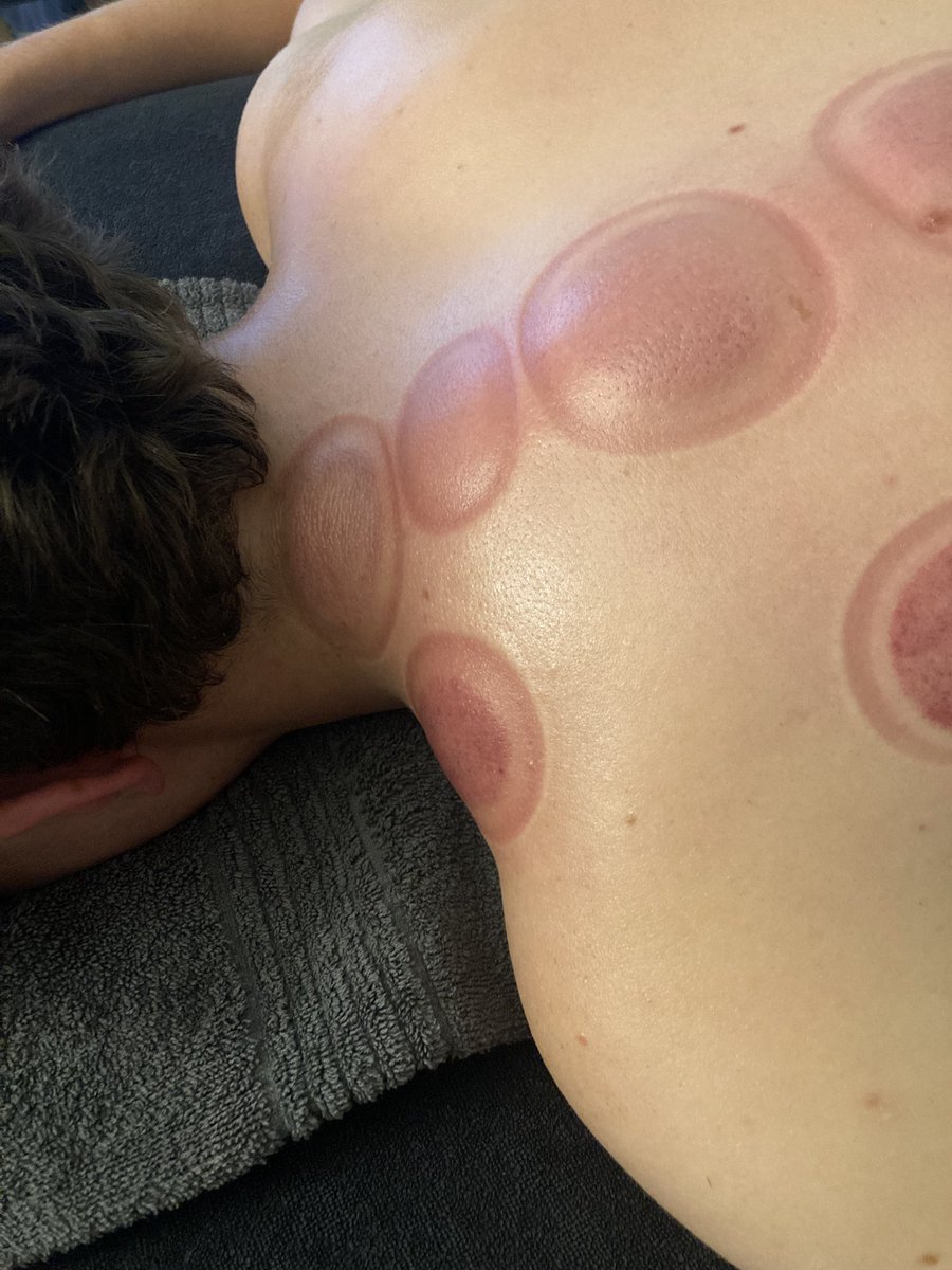 HughesMassage's tweet photo. Cupping is a great treatment to alleviate pain and tension - can be used as a stand-alone treatment or as part of a massage. 

#massage #drycupping #cupping #myofascialdrycupping #sportsmassage #sleaford #Lincolnshire #PainRelief #muscletension #tensionrelease https://t.co/ZN72wKOBhk