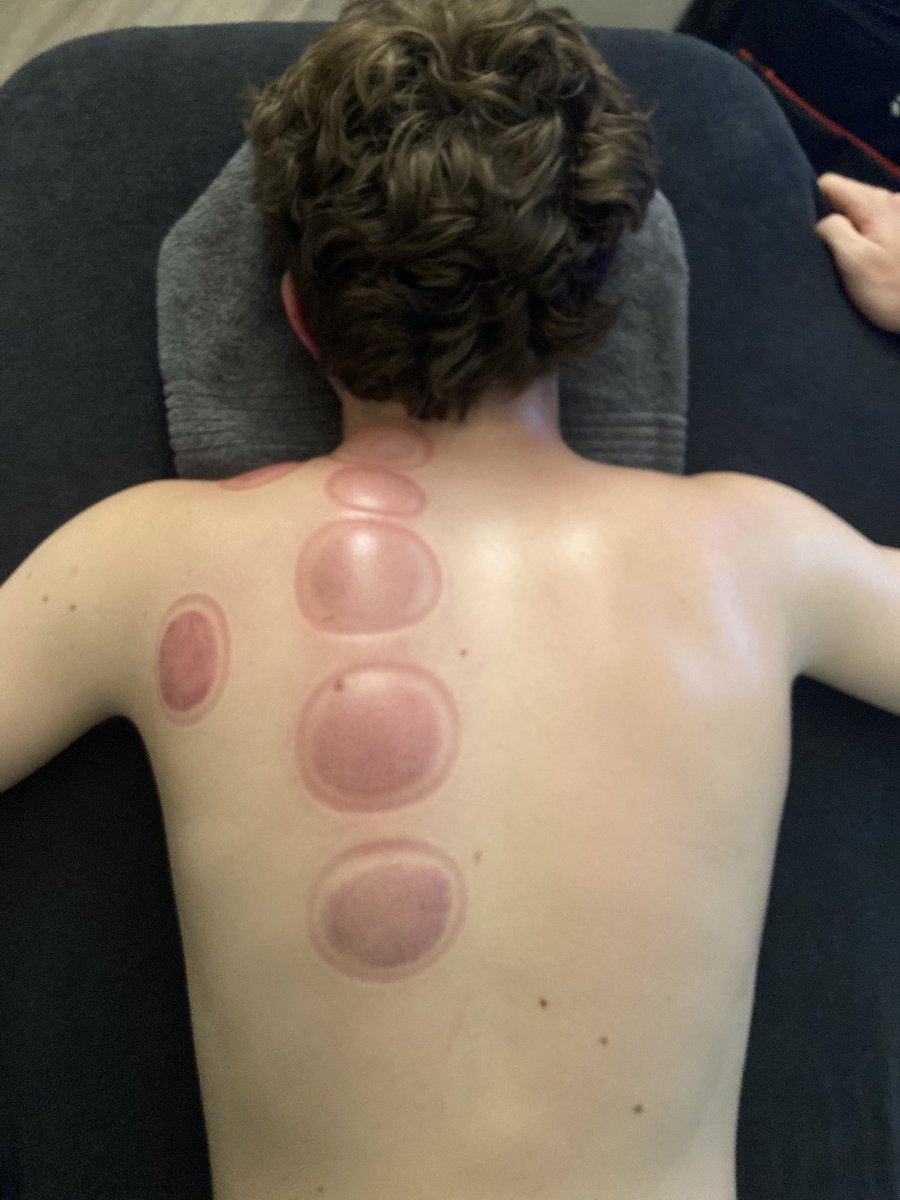 HughesMassage's tweet photo. Cupping is a great treatment to alleviate pain and tension - can be used as a stand-alone treatment or as part of a massage. 

#massage #drycupping #cupping #myofascialdrycupping #sportsmassage #sleaford #Lincolnshire #PainRelief #muscletension #tensionrelease https://t.co/ZN72wKOBhk