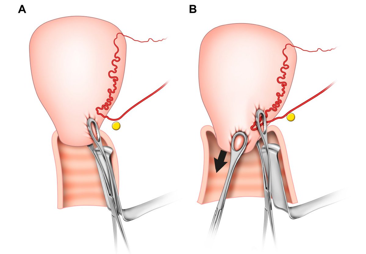 AJOG Surgeons Corner:  Vaginal Clamping of Uterine Arteries: A Temporary Intervention to Stop Bleeding in Postpartum Hemorrhage ow.ly/2CwO50WoKEy