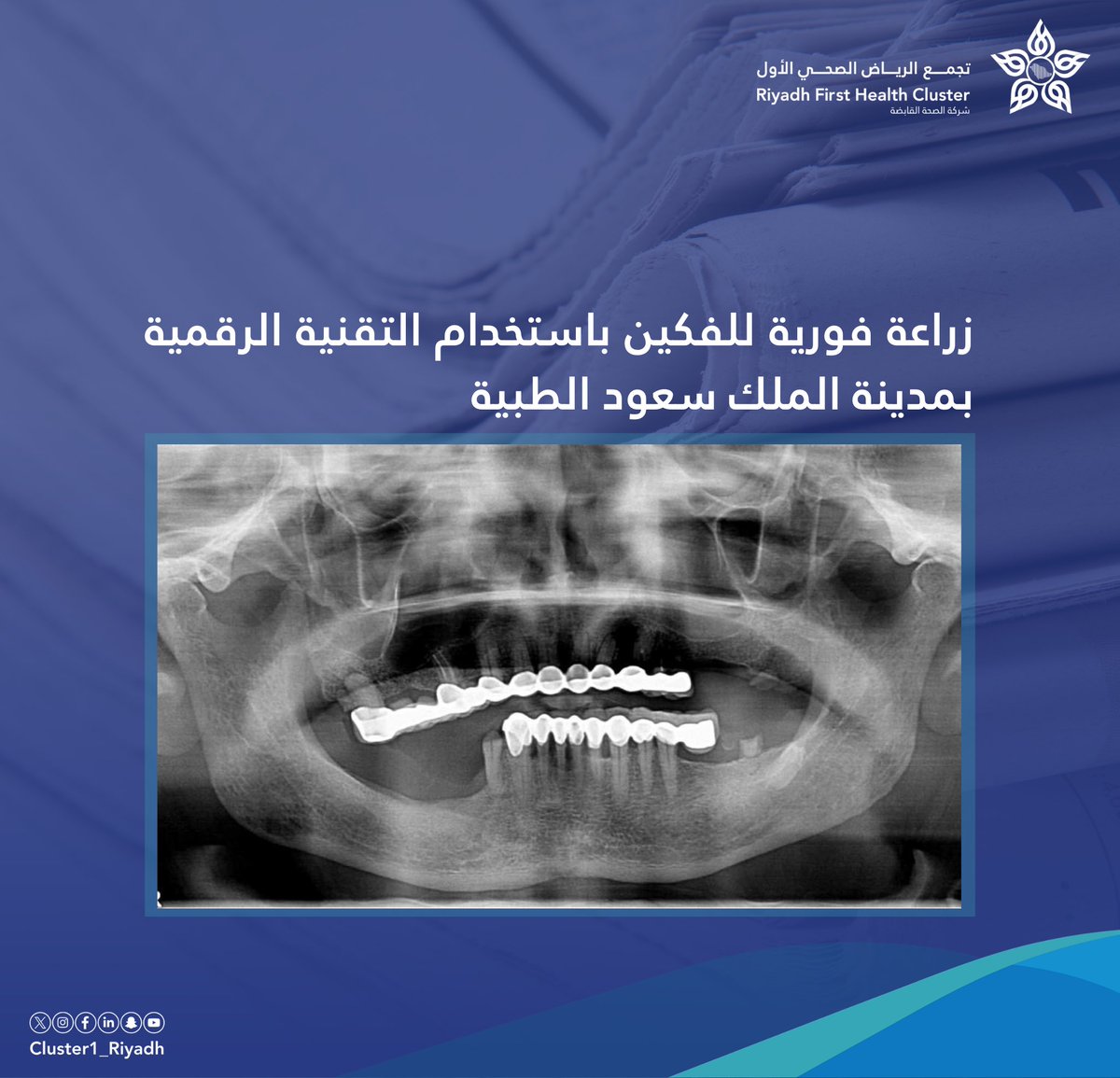 🗞️| زراعة فورية للفكين باستخدام التقنية الرقمية بمدينة الملك سعود الطبية.

alriyadh.com/2141020
