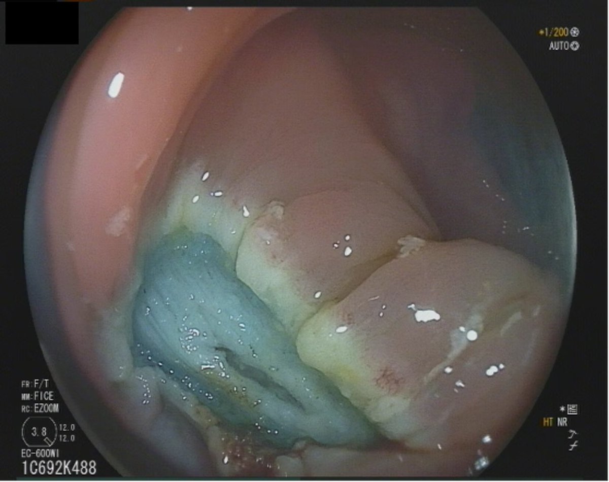 EndoCollab™ | GI Endoscopy Community tweet media