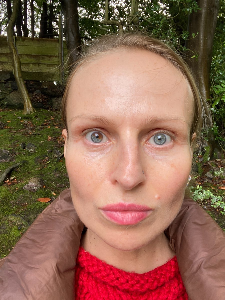 🗣️ Name: Magdalena
❤️ Skin concern: Hyperpigmentation
⏰ Treatment length: 3 months

"I didn’t think something can really work until I tried Dermatica. I can see amazing results after only 3 months of using this magic cream” 

#antiaging #beforeandafter #skincare #tretinoin