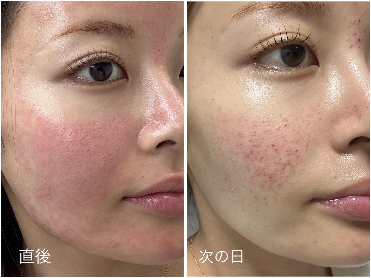 _moonlight_00_'s tweet image. 📍🇰🇷ザウェルネスクリニック(@thewellnessjpn )
「キュアジェット×ジュベルック」の毛穴治療を受けてきました🌿
エアジェットで高圧導入するから、針を使わずに薬剤を肌の奥までしっかり届けてくれて、施術中の痛みはほとんどなし!…