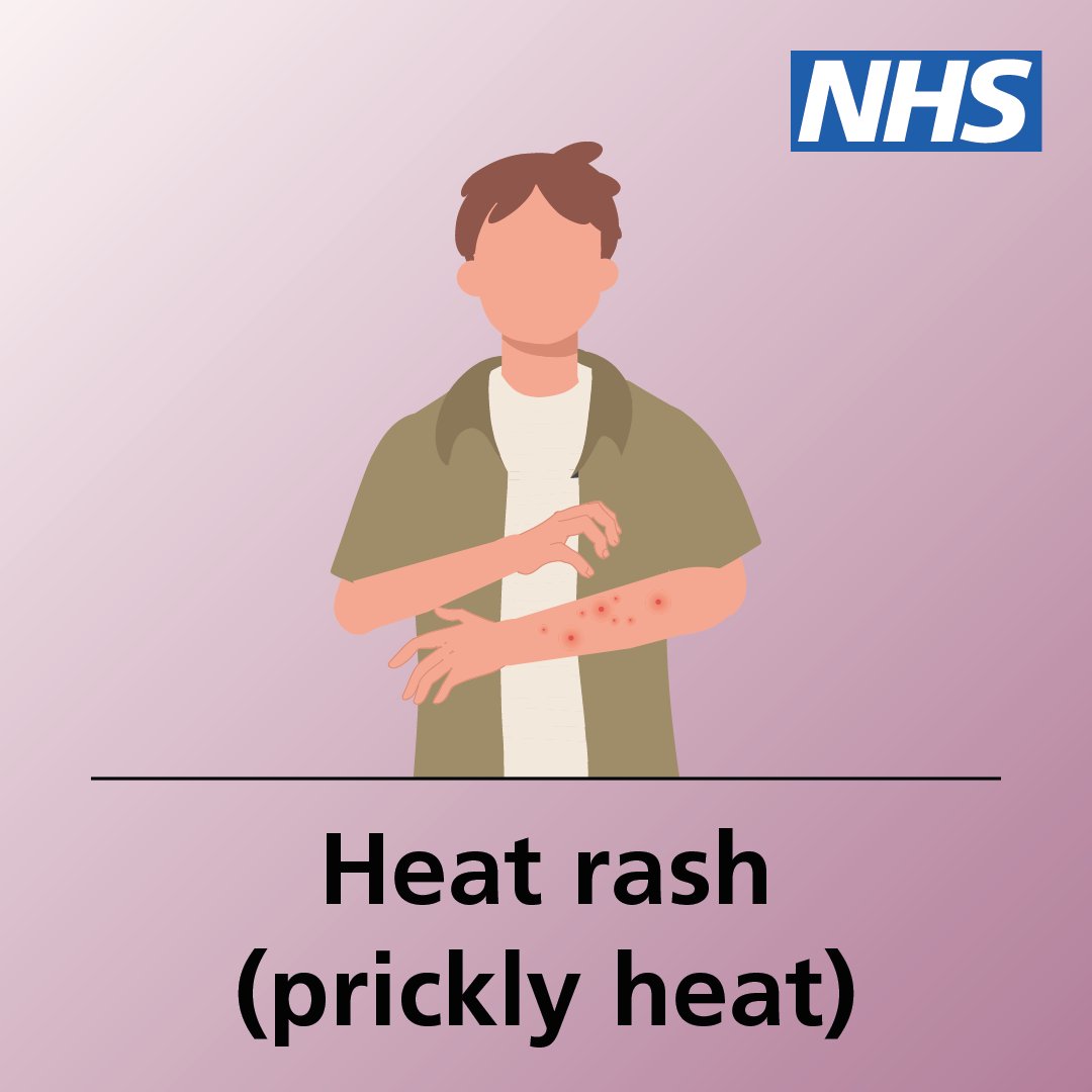 NHSuk's tweet image. Heat rash is common during hot weather.
It is uncomfortable - but usually harmless - an it usually gets better on its own after a few days.
Here are some tips to help you check if you have heat rash – and advice on how to treat it.
More info ➡️ nhs.uk/conditions/hea…