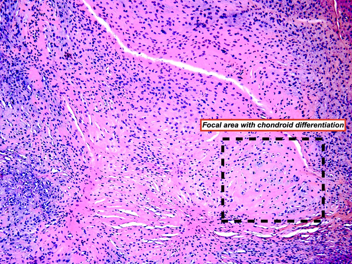 Hashimoto__0's tweet image. Ectomesenchymal Chondromyxoid Tumor
Synonyms: Oral myoepithelioma of soft tissue origin; reticulated myxoid tumor of the 👅; myoepithelioma of the 👅
Benign mesenchymal neoplasm of unknown histogenesis characterized by spindle-polygonal cells within myxoid-collagenous stroma &…