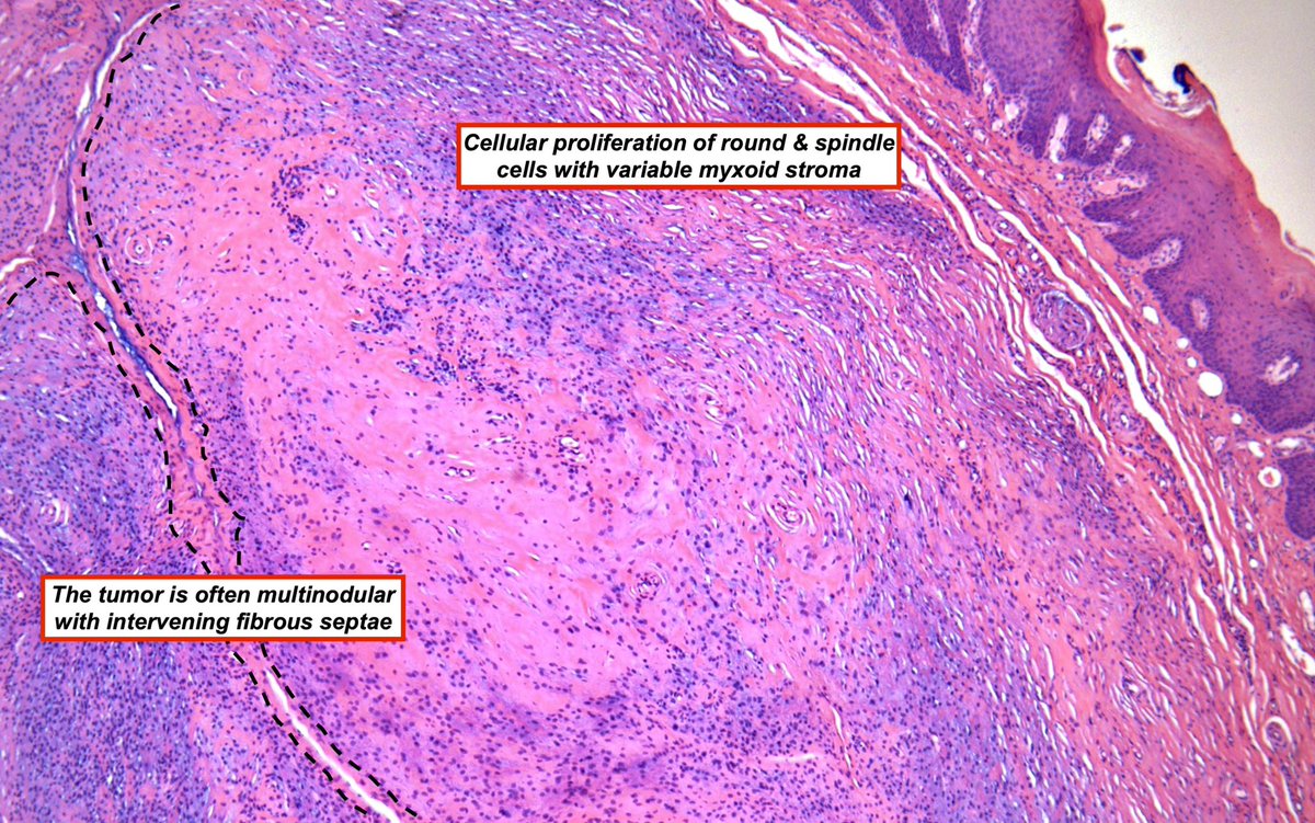 Hashimoto__0's tweet image. Ectomesenchymal Chondromyxoid Tumor
Synonyms: Oral myoepithelioma of soft tissue origin; reticulated myxoid tumor of the 👅; myoepithelioma of the 👅
Benign mesenchymal neoplasm of unknown histogenesis characterized by spindle-polygonal cells within myxoid-collagenous stroma &…