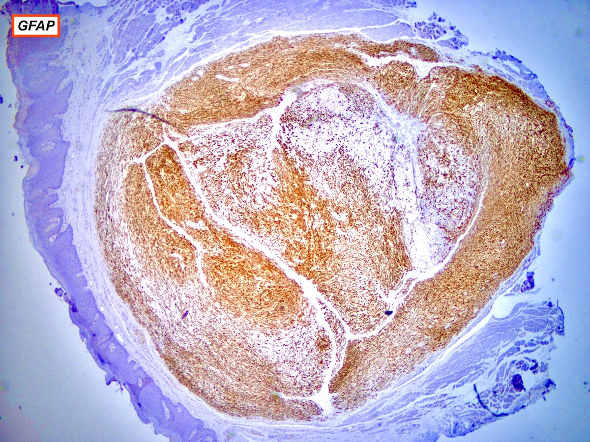 Ectomesenchymal Chondromyxoid Tumor

Synonyms: Oral myoepithelioma of soft tissue origin; reticulated myxoid tumor of the 👅; myoepithelioma of the 👅 

Benign mesenchymal neoplasm of unknown histogenesis characterized by spindle-polygonal cells within myxoid-collagenous stroma &amp;