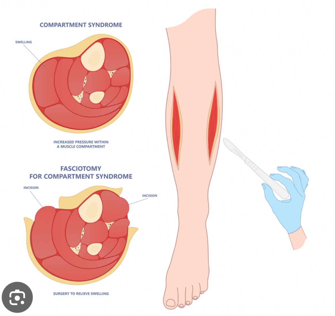 Compartment Syndrome VS  Shin Splints 

كثير يخلطون بين لأن ألمهم متشابه ويجي بالساق، لكن بينهم فروقات مهمّة 👇🏻