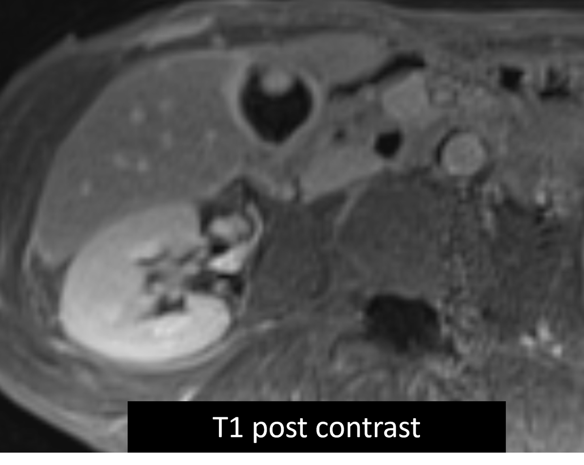 SAR DFP Benign Biliary Pathology (@sarbiliarydfp) on Twitter photo Challenge yourself with a case brought to you by Malak Itani, MD <a href="/ItaniMalak/">Malak Itani</a> from <a href="/WashUMedMIR/">WashU Medicine Mallinckrodt Institute of Radiology</a>:
70M with RUQ pain x 1 week with nodular thickening of the GB wall, superimposed on changes of cholecystitis on initial CT, s/p cholecystostomy tube on MR. Challenge yourself with a case brought to you by Malak Itani, MD <a href="/ItaniMalak/">Malak Itani</a> from <a href="/WashUMedMIR/">WashU Medicine Mallinckrodt Institute of Radiology</a>:
70M with RUQ pain x 1 week with nodular thickening of the GB wall, superimposed on changes of cholecystitis on initial CT, s/p cholecystostomy tube on MR.