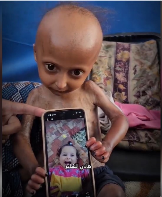 💔FORCED STARVATION IN GAZA. 
        This is its devastating impact!
#Gaza #GazaForcedStarvation #EthnicCleansing