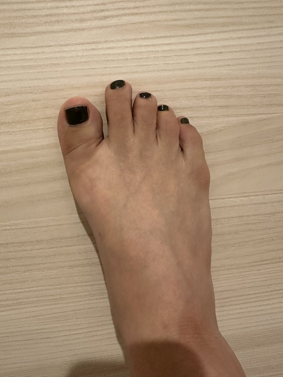 エスワンタイホウ
色素沈着経過観察15
2クール5日目
４日目は投稿忘れ

とくに副作用なし

手先が黒くなってきたような…でも写真で見るほど実物は黒くなっていない
日焼けしていないのに手のこう全体の色が良くない
#経口抗がん剤
#抗がん剤
#エスワンタイホウ
#色素沈着
#乳がん
#ルミナールb