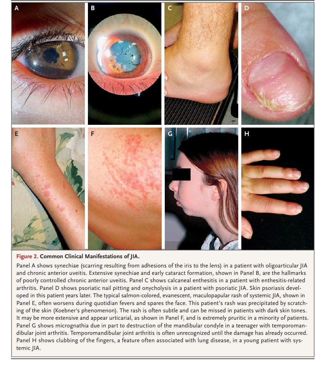 🧵1/ Juvenile Idiopathic Arthritis (AIJ) – NEJM 2025
Una de las enfermedades reumatológicas más complejas de la infancia 👧🧑
🧵2/ ¿Qué es la AIJ?
No es una sola enfermedad, sino un grupo de artritis crónicas pediátricas:
🔹 Oligoarticular
🔸 Poliarticular (FR− / FR+)
🟢