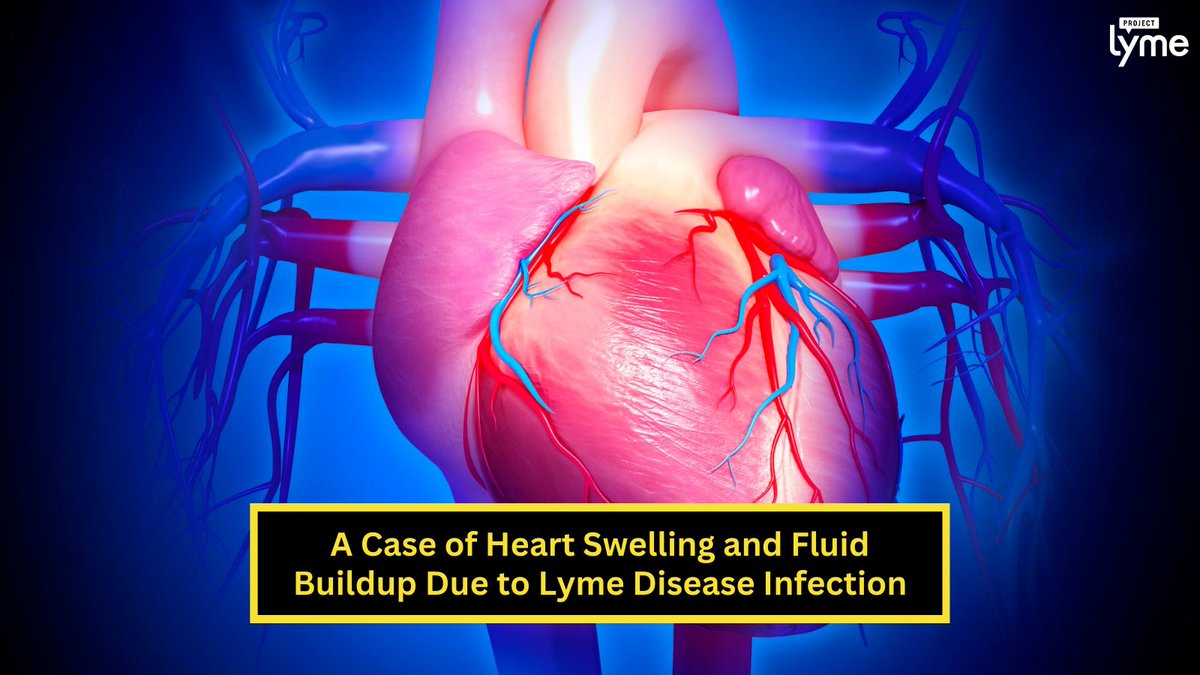 ProjectLyme's tweet image. A 69-year-old woman had chest pain & trouble breathing due to inflammation & excess fluid buildup around her heart. After ruling out other possibilities, she tested positive for Lyme disease. Thanks to a timely diagnosis, she recovered. Via @CureusMedical cureus.com/articles/33818…