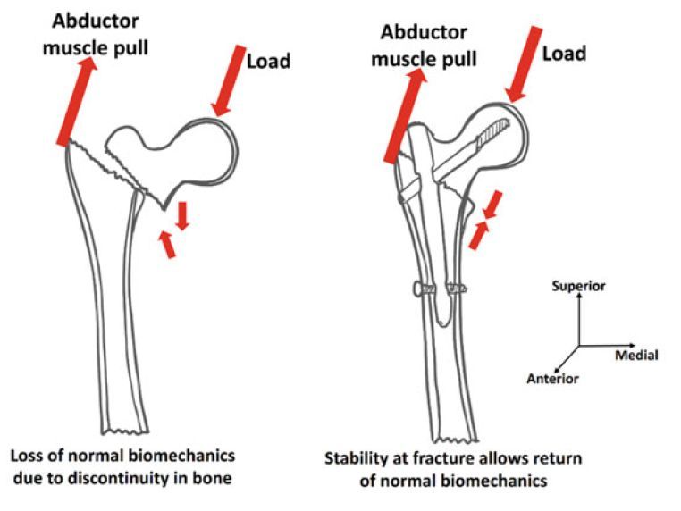 Physiological forces acting on the bone caused deformities in the presence of  a fracture.This
Deformity  is reversed by fixation in reduced position
