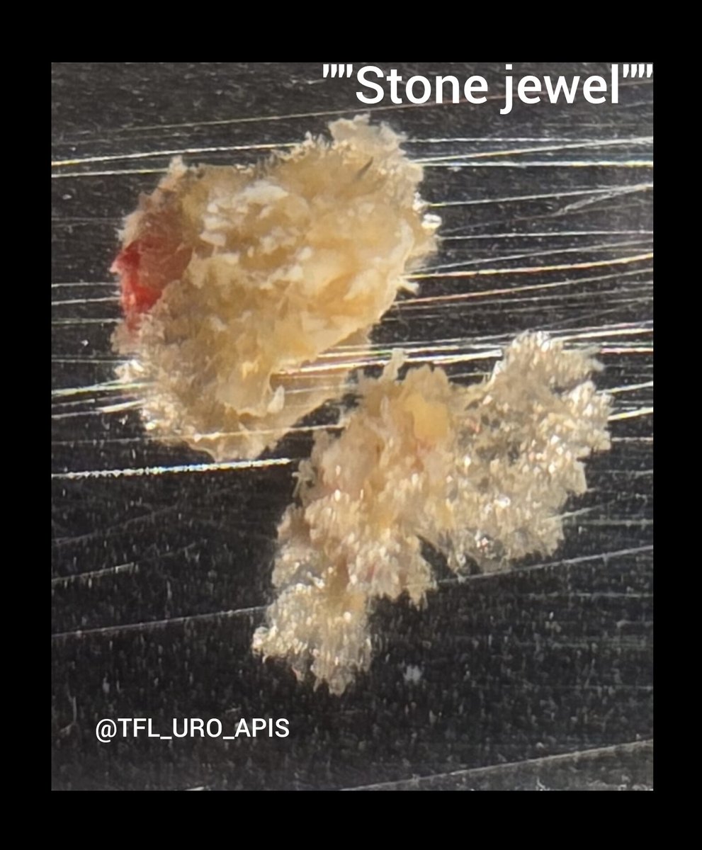 Stone photography 
1.Stones are beautiful : stone jewel <a href="/so_uro/">UroSoMe</a> #UroSoMe #RIRS #RIRSZsSystem #RIRSDISSzstechnique #kidneystones
