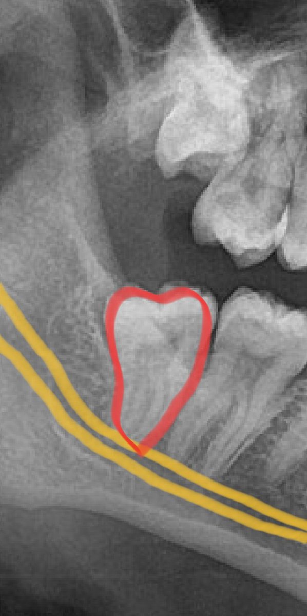 فتاة في العشرينات من عمرها
متضايقة من وجود اضراس العقل
متخوفة كثير من خلعها بسبب قربها من العصب السنخي
Inferior alveolar nerve
كما يتضح في الصورة المرفقة

ضرس العقل السفلي الايمين
Right Lower 3rd molar
الضرس محدد باللون الاحمر
مجرى العصب السنخي محدد باللون الاصفر