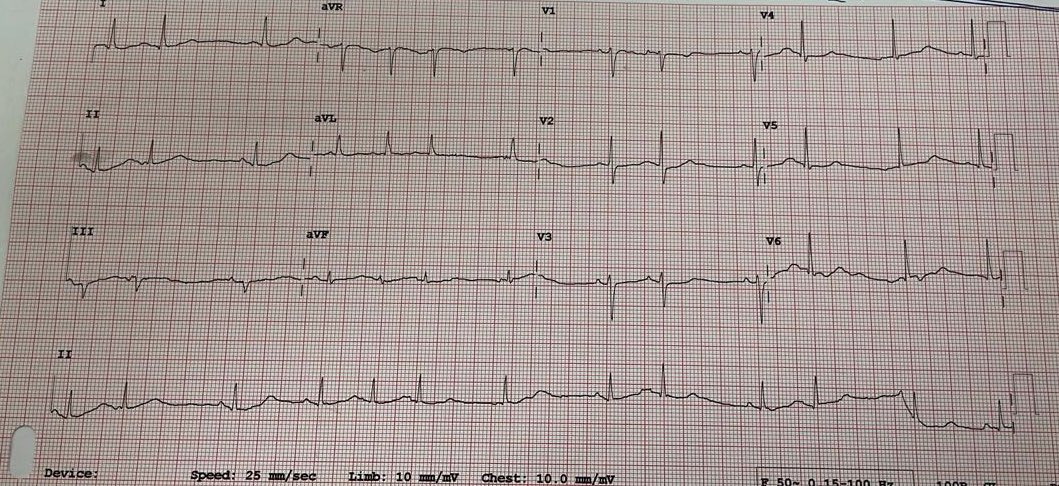 Rhythm?
<a href="/ecgandrhythmRoe/">Dr. Andreas Roeschl</a> <a href="/DrRazi4/">Dr Razi</a>