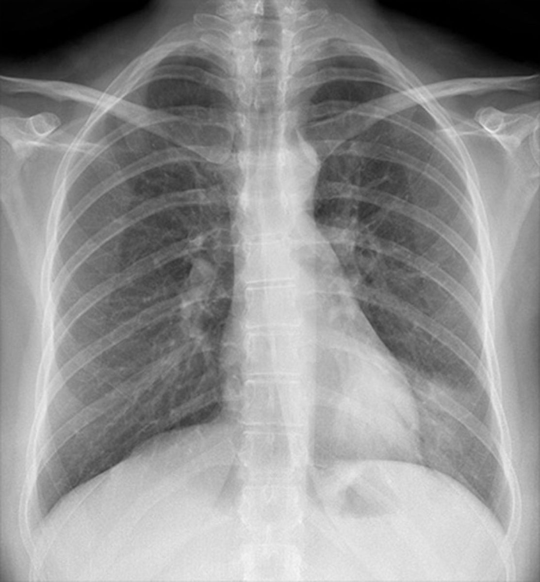 CHEST X-RAY 17: What is the subtle abnormality? Answer buff.ly/42eWLLP