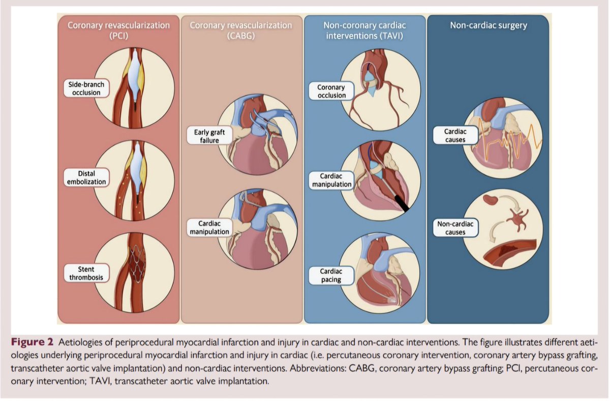 javier20ch's tweet image. 📌Infarto &amp;amp; Lesión de Miocardio Periprocedimiento. 🧐🫀💥
🔺️A pesar de los notables avances perioperatorios y los avances en seguridad, las ICP y CABG conllevan un riesgo pequeño pero considerable de complicaciones agudas, como muerte perioperatoria, ACV e infarto de miocardio.…