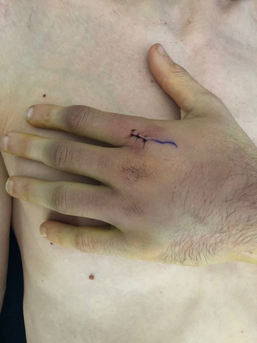 alexmarquez73's tweet image. Todo trabajo tiene su recompensa. Así tenía la mano hace 12 días y hoy poder estar en el podio es maravilloso😃