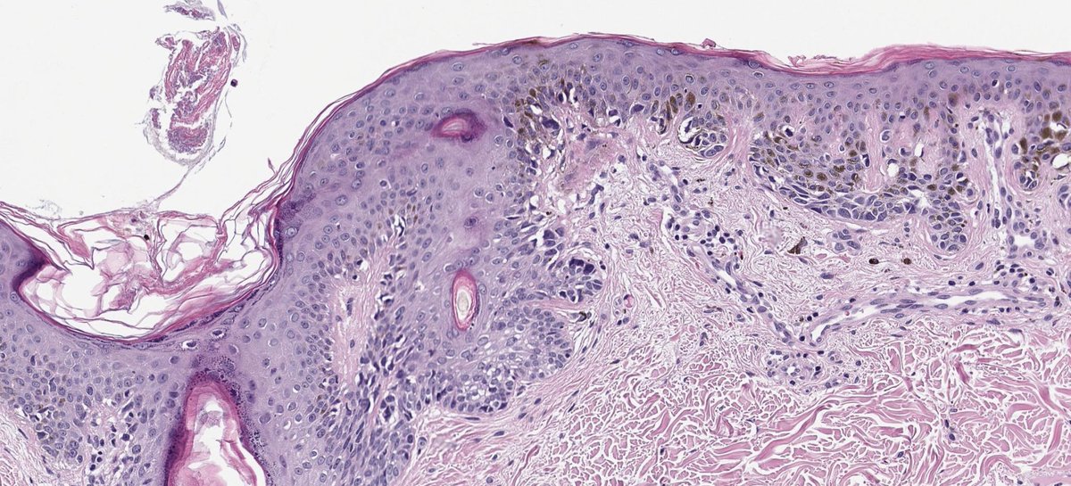 Nice reminder: Periadnexal invasion IS NOT exclusive to melanoma.
Skin excision from a 26-year-old man.
High-grade dysplastic nevus with  adnexal invasion. 

Great mimic!! 

#dermpath #PathTwitter #dermtwitter