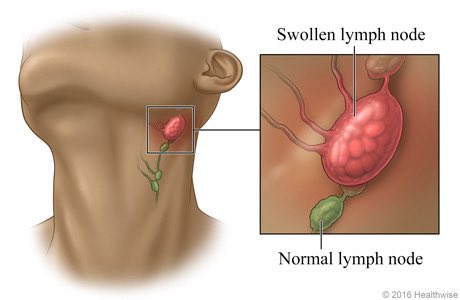 evacguy1's tweet image. Had a swollen gland along with inflammation
And just kept throwing aspirin water mixed with thyme at it, which fixed it immediately
Thank u peatards
