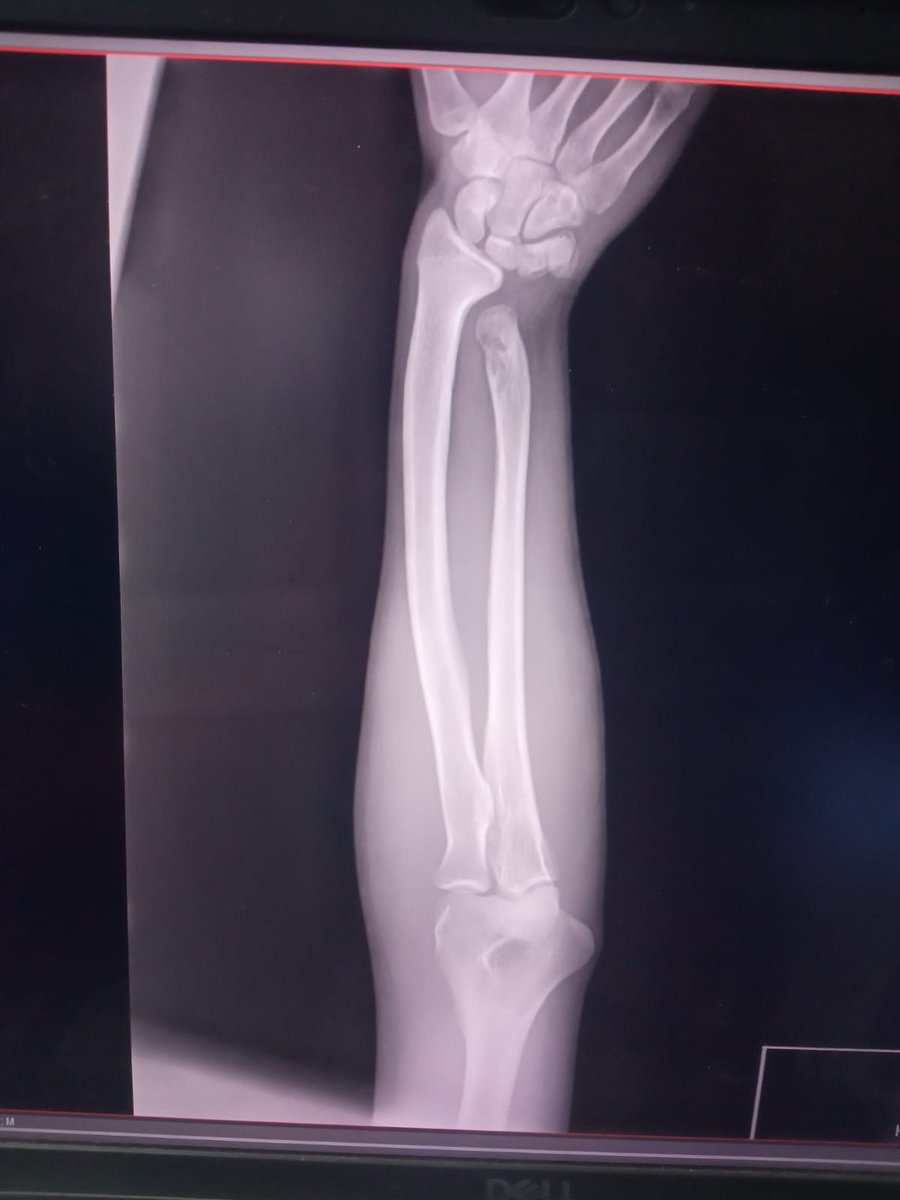 ygaza7732's tweet image. Hello, I am crying from the severity of the pain in my hand. Unfortunately, no one cares about me. No one is donating to me. I cannot buy treatment and we have run out of food. I am living in very terrifying conditions. Please donate before it is too late. I need you.๐โฆ