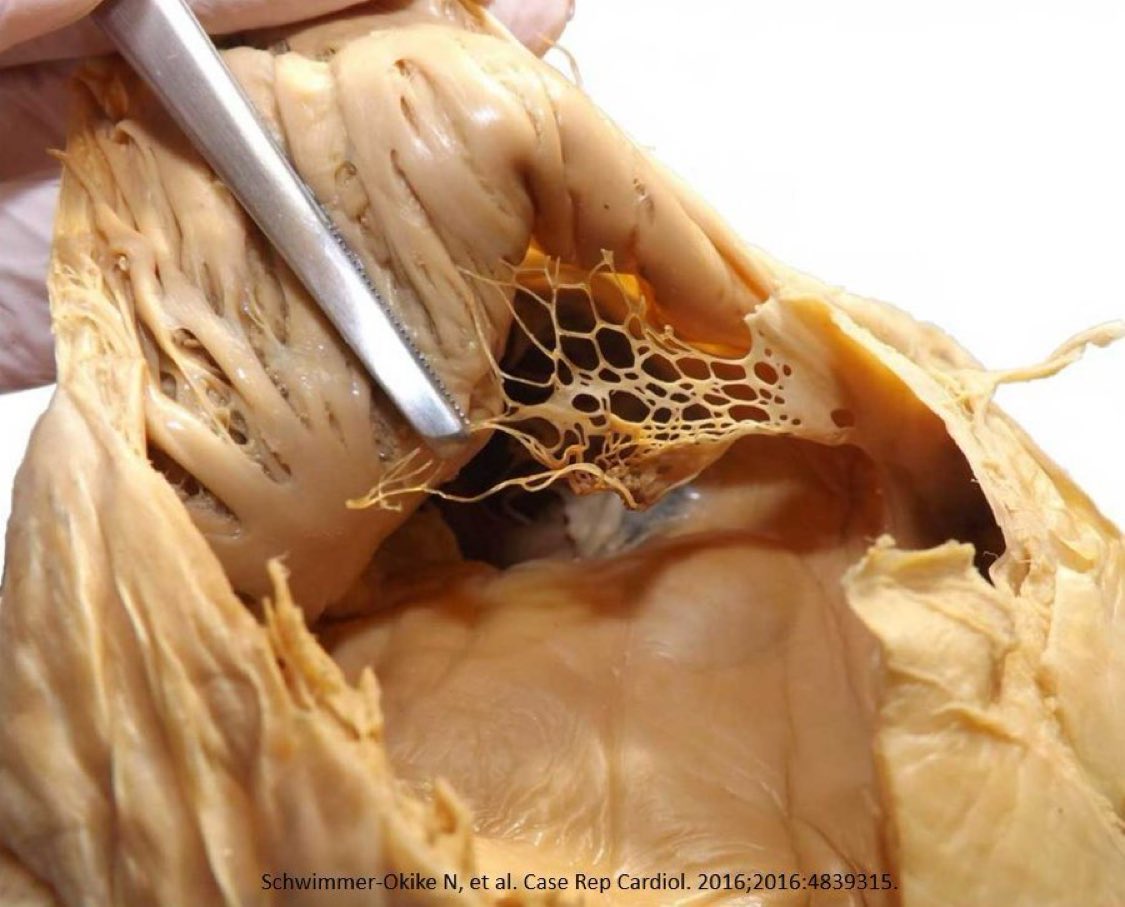 MujeebZubair's tweet image. What’s this structure in the right atrium that could be mistaken for a thrombus or other abnormality on ? 

Chiarri network !