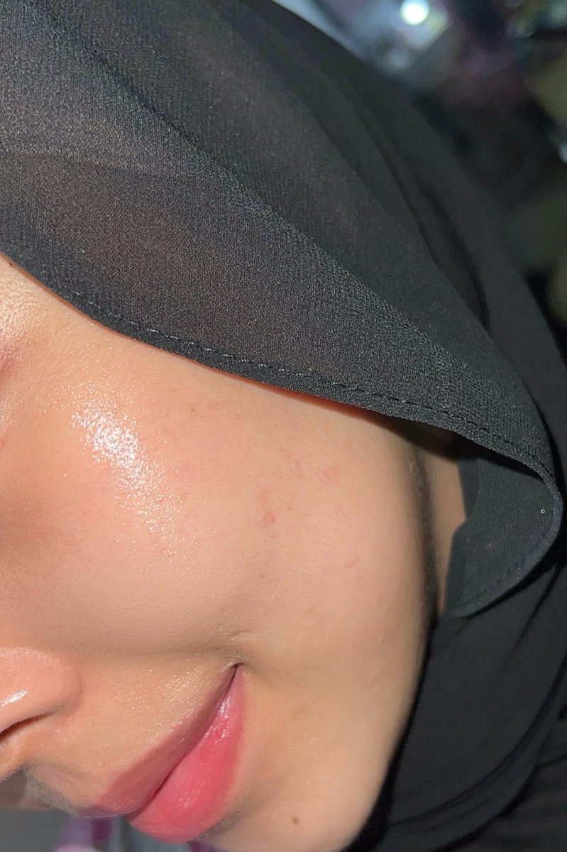 _friedciken's tweet photo. Minggu lepas tak ada mood nak keluar rumah. Only those struggling with acne can relate. Pakai makeup pun rasa tak cantik... 

Ni kulit i minggu lepas vs sekarang: https://t.co/ezB8z8mwci