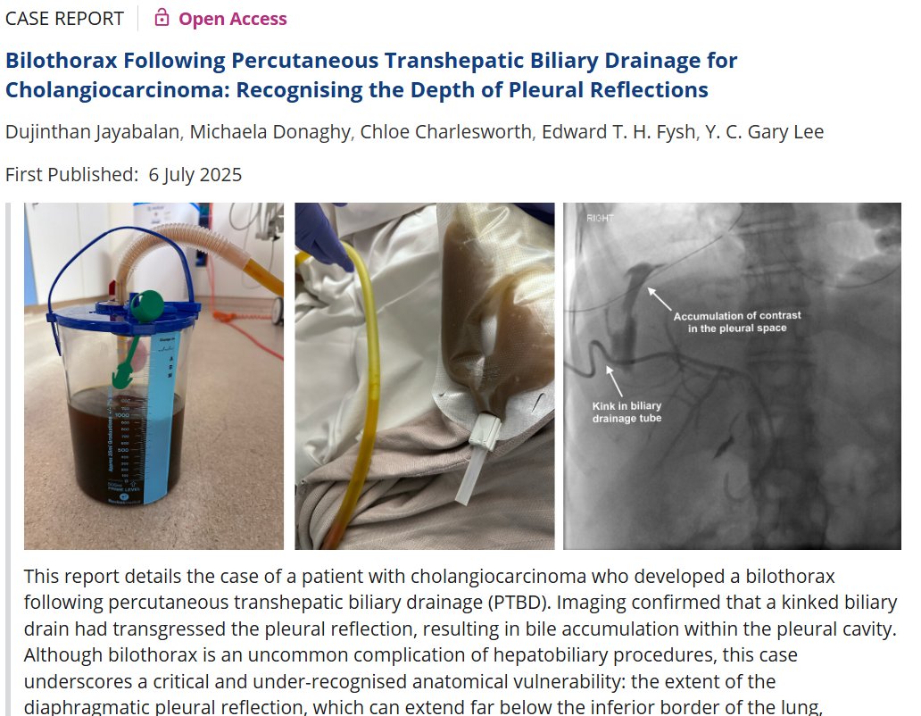 YCGaryLee's tweet image. #PLEURAL_PEARLS_WA 35
Diaphragmatic #pleural reflection extends far below the #lung esp posterio-laterally. Percutaneous hepatic procedures often transgress the pleura; any bleeding or bile leak (see doi.org/10.1002/rcr2.7…) can accumulate as pleural effusion.
#LiverTwitter…