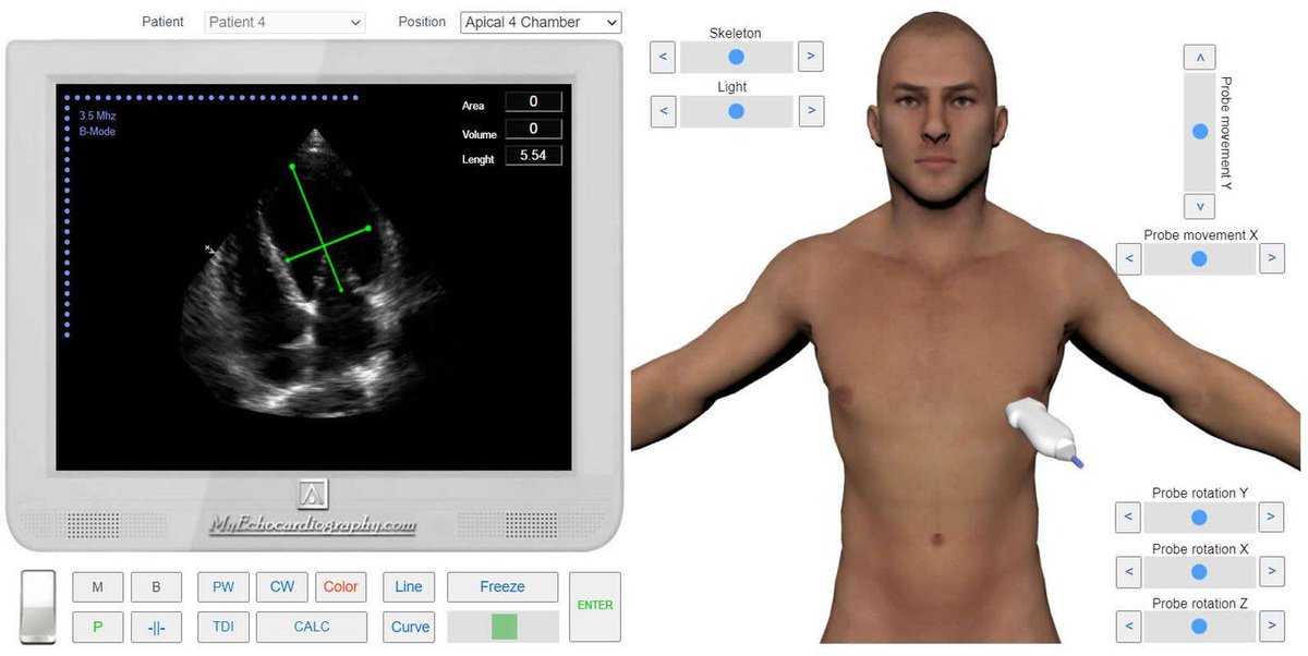 LINEAR MEASUREMENTS OF THE LEFT VENTRICLE

Read more: myechocardiography.com/MeasurementsLi…