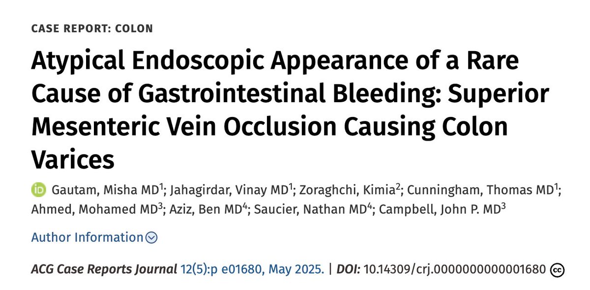 Misha Gautam, MBBS (@mishagautam55) on Twitter photo 🔎Colonic Varices: A rare but serious cause of GIB🔍
See our ACG Case Report for a high-yield flowchart for management included!
pubmed.ncbi.nlm.nih.gov/40309560/
<a href="/DocGIJohn/">John P. Campbell, MD/MBA</a> <a href="/vinayjaha/">Vinay Jahagirdar</a> <a href="/umkcIM/">UMKC Internal Medicine Residency Program</a> <a href="/AmCollegeGastro/">ACG</a>
#GITwitter #MedTwitter 🔎Colonic Varices: A rare but serious cause of GIB🔍
See our ACG Case Report for a high-yield flowchart for management included!
pubmed.ncbi.nlm.nih.gov/40309560/
<a href="/DocGIJohn/">John P. Campbell, MD/MBA</a> <a href="/vinayjaha/">Vinay Jahagirdar</a> <a href="/umkcIM/">UMKC Internal Medicine Residency Program</a> <a href="/AmCollegeGastro/">ACG</a>
#GITwitter #MedTwitter
