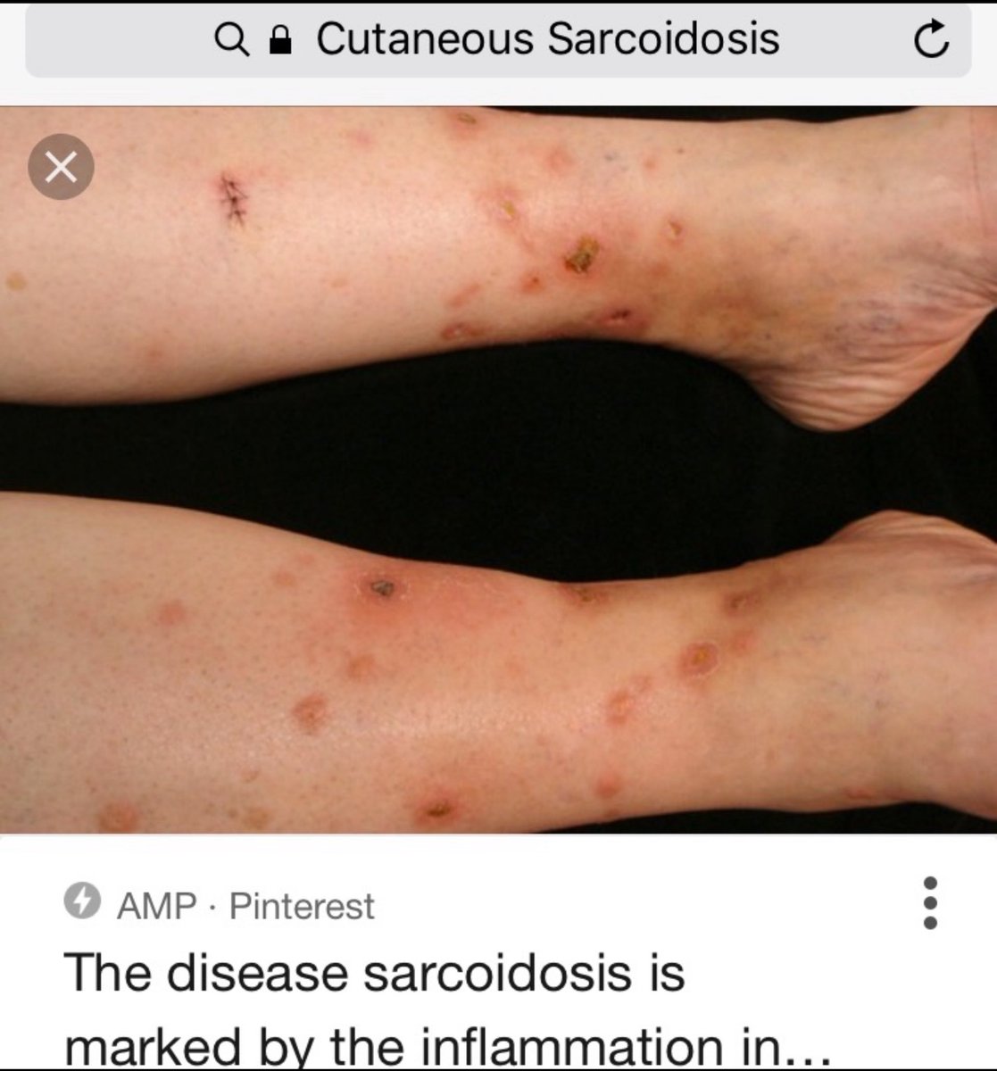 jmkillingnyc's tweet photo. @Darkmdd @slantofreality YES!!! I have a real life example of how Communistic Civil Rights Violating @DOJBJA funded #PDMP Discriminatorily Profiles US Citizens. My rare inherited disease Progressive Sarcoidosis goes ballistic from Sunlight exposure. I had to see three different physicians (Internist, Dermatologist and Psychiatrist) after I watched the 2018 Solar Eclipse for Cutaneous Sarcoidosis mimicking Syphilis (Sarcoidosis mimics every disease) I was prescribed a two courses of Cephalexin, oral immunosuppressant, 14 day course of Doxycycline, three different tubes of varying strength prescription steroid creams, prescription antibiotic ointments, oral antifungals and Xanax. Out of all those pharmaceuticals prescribed ONLY the XANAX is listed in the @DOJBJA funded #Narxcare #BambooHealth #PrescriptionDrugMonitoringProgram #PDMP
The #PDMP is a Genetics Discriminatory profiling surveillance monitoring system straight out of a Communist Regime. It has no place in a civilized nation. I was born with my rare progressive bodily disease which makes their profiling monitoring surveillance system omitting all my non-scheduled pharmaceuticals a glaring Genetics Discrimination Violation. They are selectively picking ONLY the scheduled pharmaceuticals prescribed to me out of my vast non-schedule pharmaceutical regiment to wrongfully re-identify me as an Addiction Risk so the @DEAHQ @USAttorneys @TheJusticeDept can unlawfully incarcerate any physician willing to prescribe scheduled pharmaceuticals for an immensely painful incurable progressive bodily disease void of any humane or effective non-schedule preventative management options. The @USAttorneys @DEAHQ @TheJusticeDept damn well knows they have no case if the PDMP lists all the pharmaceuticals prescribed to me like consecutive courses of literally every antibiotic, antifungals, diuretics, beta-blockers, steroids creams, antibiotic ointments, bronchodilators, immunosuppressants just to name a few.
Their monitoring system is specifically designed to Unconstitutionally profile and criminalize me (and all my pain patient peers) as an Addiction Risk for their own self enrichment rather than the correct identity me as an American Citizen afflicted with Familial Progressive Multiple Vital Organ Sarcoidosis. They made Xanax specifically for the type of anxiety I have knowing if the next Cutaneous Sarcoidosis infiltration happens to my face my Nose will rot off. I’m strong (a lot stronger than the filth viciously targeting us) but everyone has their limits. My Father needed Xanax to cope with the most unforgiving and rarest Sarcoidosis manifestation. The disease literally devoured his entire reproductive system. The pain he endured is unspeakable.
@supportprop @JudyRummler @ShatterproofHQ @Pharmed_Out @StanfordPain @michigan_open are sleazy shameless self-enriching #BelmontReport violating predators who invaded the lives of innocent people with the rarest diseases for needing pain and suffering pharmaceuticals. They are a hateful bunch of barbaric monsters. They all need to be shamed and I mean really fucking relentless shamed. They ONLY want to use our bodies deteriorating from disease and injury as a commodity to humiliate and violate.
I am a quintessential pain patient proud to be a member of the pain community. I dare these Addiction Industry Profiting Exploitive Bigoted Court Grifting Scum to tell me that I have “lower back pain” and just looking to get high from pharmaceuticals. All they can do is cowardly block, silence and steamrolled me from telling the truth. The @CDCgov cowardly solution to keep their profitable NO quality evidence 2016 Guidelines that Sarcoidosis debunks is refuse to acknowledge the disease exists. I have more proof my dangerous and deadly rare disease is real than they have proof Opioid Use Disorder is real. I don’t need to make up my real disease using Suboxone peddling psychobabble.