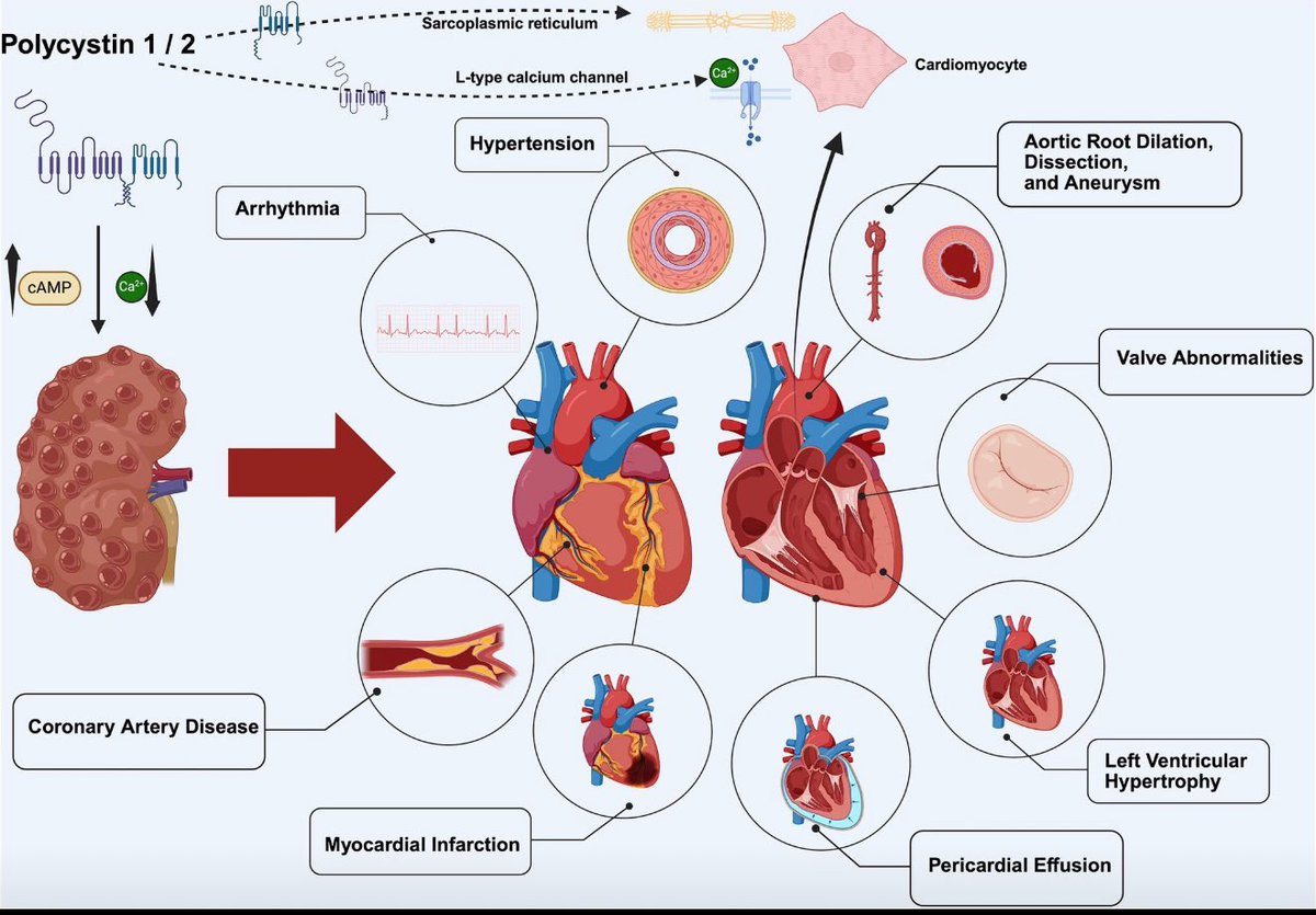 ⭐️⭐️Exploring Cardiac Abnormalities in PKD: A Deeper Look ⭐️⭐️

kireports.org/article/S2468-…

It's fascinating yet concerning that cardiac symptoms, especially valve issues (in my opinion), might not receive the attention they deserve in our routine clinical practice.

Let’s shine a