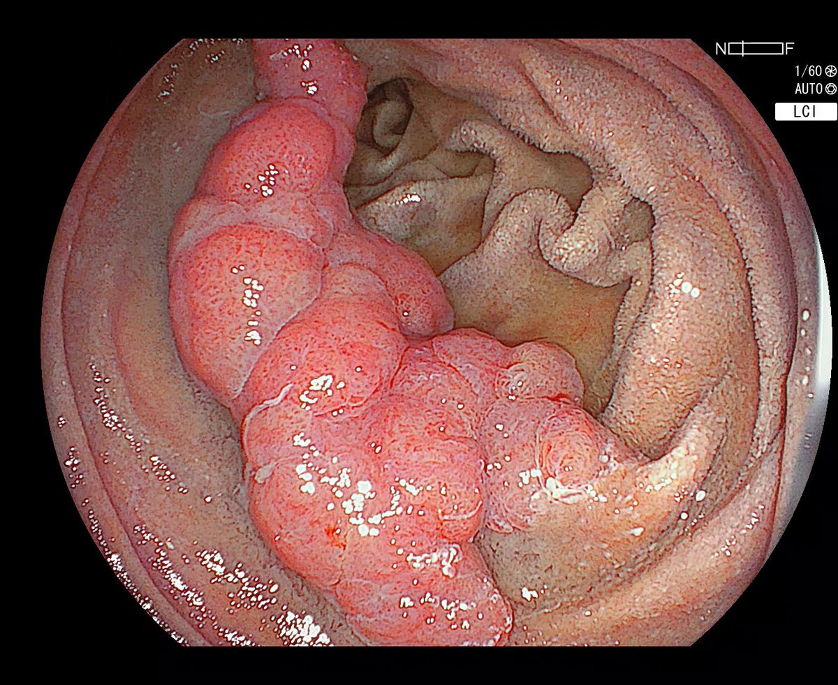 Just posted a new video demonstrating ESD of a nodular Paris 1s lesion in D2. Initial path: duodenal adenoma; updated pathology review showed foci of HGD.
Watch the case here → 
youtu.be/AVmIuFT4uCk?si…