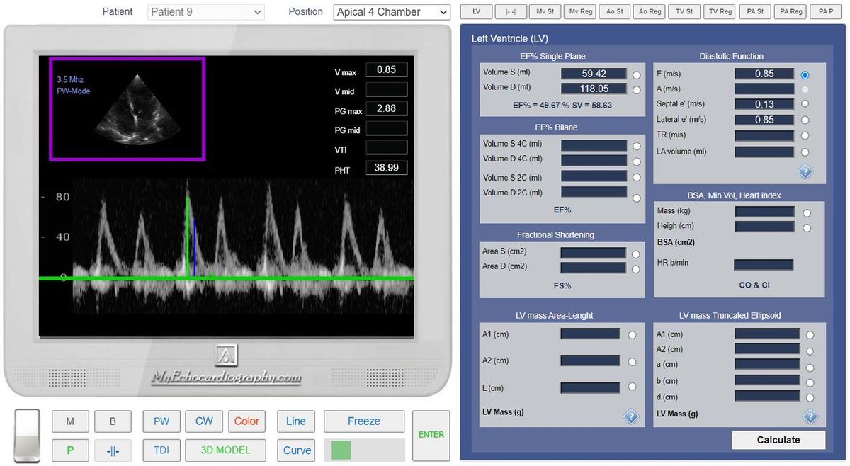 LEFT VENTRICULAR DIASTOLIC FUNCTION

Read more: myechocardiography.com/DiastolicFunct…