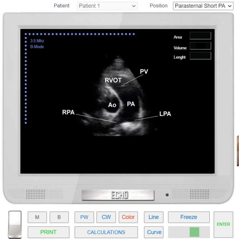 Left Parasternal View. Short axis at the level of pulmonary artery. zurl.co/r2yRn