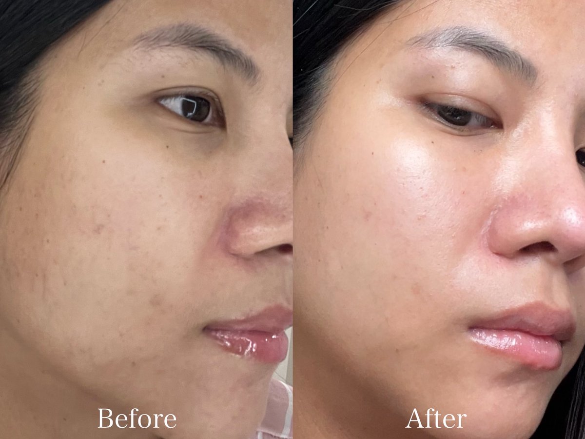 Sawarinni's tweet image. ใช้ มาส์ก ผลัดเซลล์ผิว ลอรีอัล แล้วผิวเนียนมากกกก เป็น พีลลิ่งมาส์กชมพู พวกรอยดำดูจางลงจริง ผิวดูสว่างขึ้นด้วย  แล้วใช้ง่ายมากก เขย่าขวด ทาให้ทั่วหน้า ทิ้งไว้ประมาณ 15 นาทีก็ล้างออกได้เลย ลูบหน้าแล้วผิวมันเนียน&amp;amp;ดูสดใสขึ้นตั้งแต่ครั้งแรกที่ใช้เลย ชอบมากกกกก