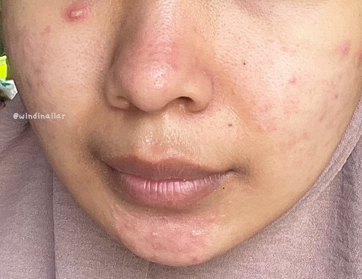 Kalo wajah udah kyk gini, berarti tandanya butuh eksfoliasi 🙂👍🏻