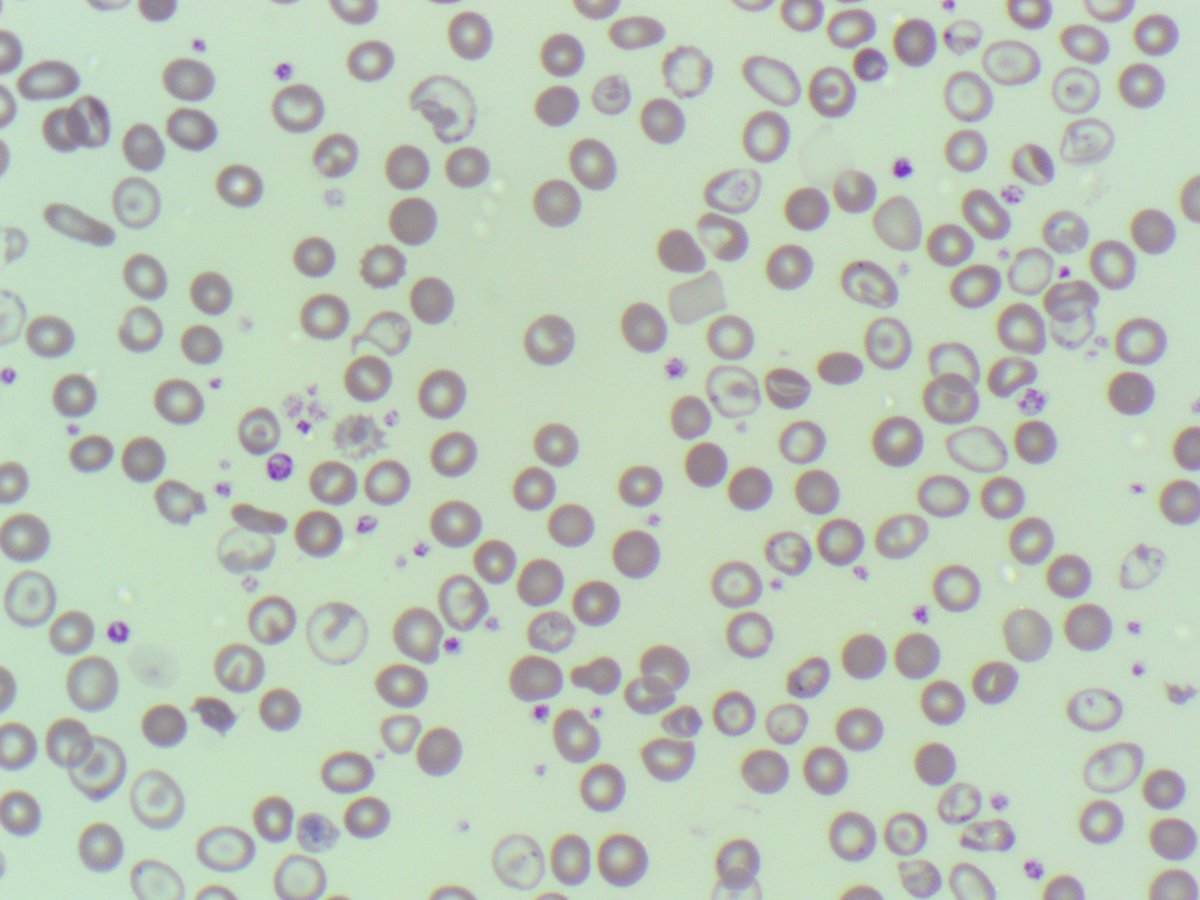 🩸#MorphologyMonday | Case MM250714

onlycells.co.uk/mm250714/

60 year old female
Hb: 84 g/L
MCV: 81 fL
RDW: 22.5%

A blood film was requested to investigate these findings further. What do you think it is?

#RedCells #BloodFilm #LabDiagnostics