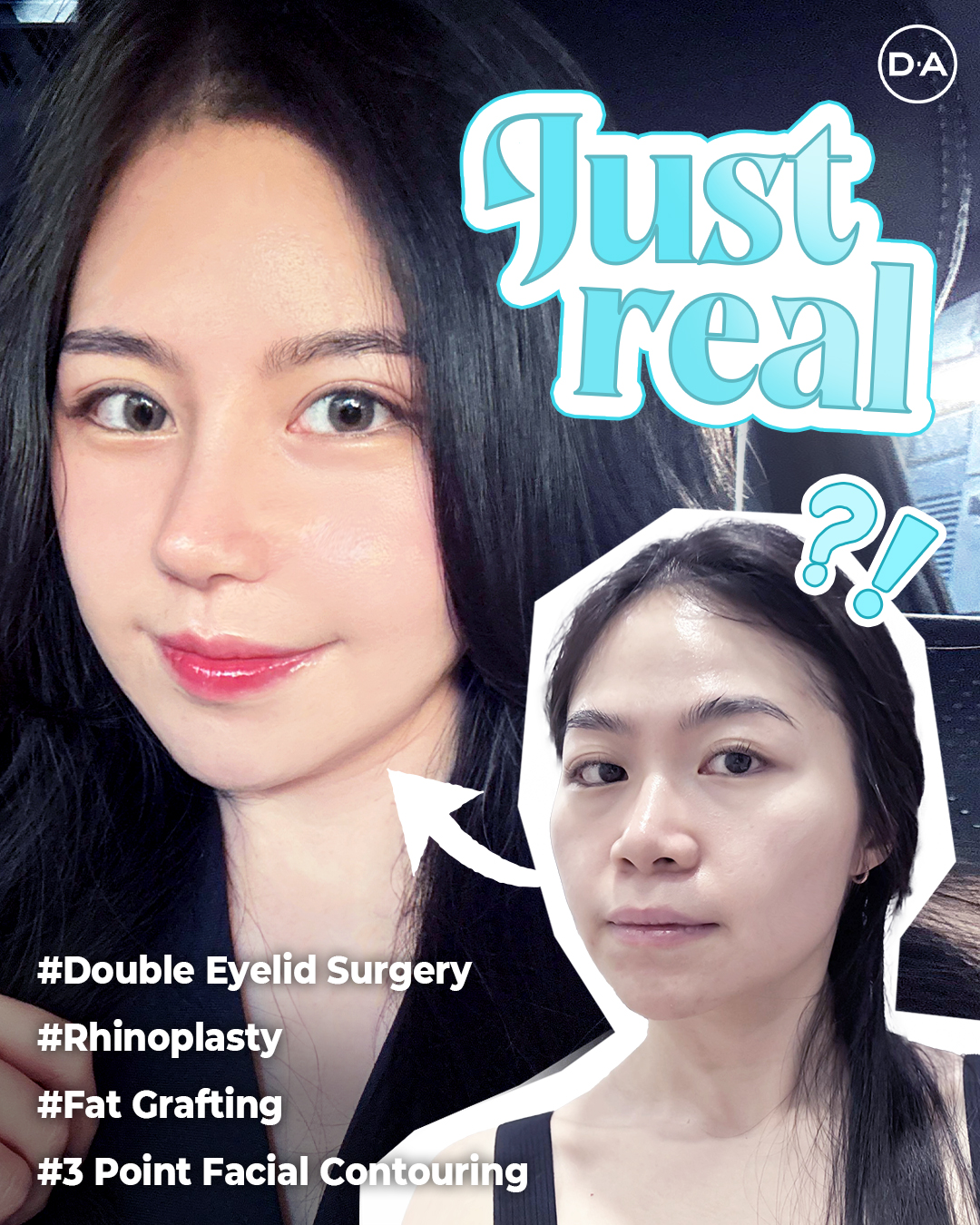 ★韓国大人気★【SURGERY】process 032 DA Plastic Surgery Korea on X: