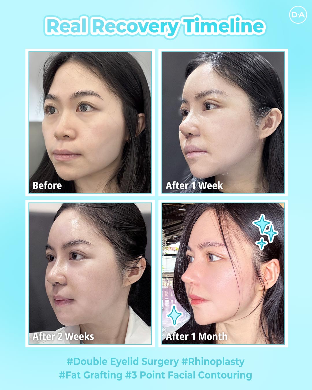 DA Plastic Surgery Korea on X: 