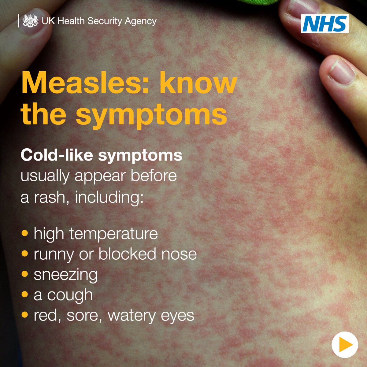 DrNighatArif's tweet image. #MeaslesOutbreak - know the signs!
Itโs a preventable disease
Please get vaccinated.
Vaccines save lives