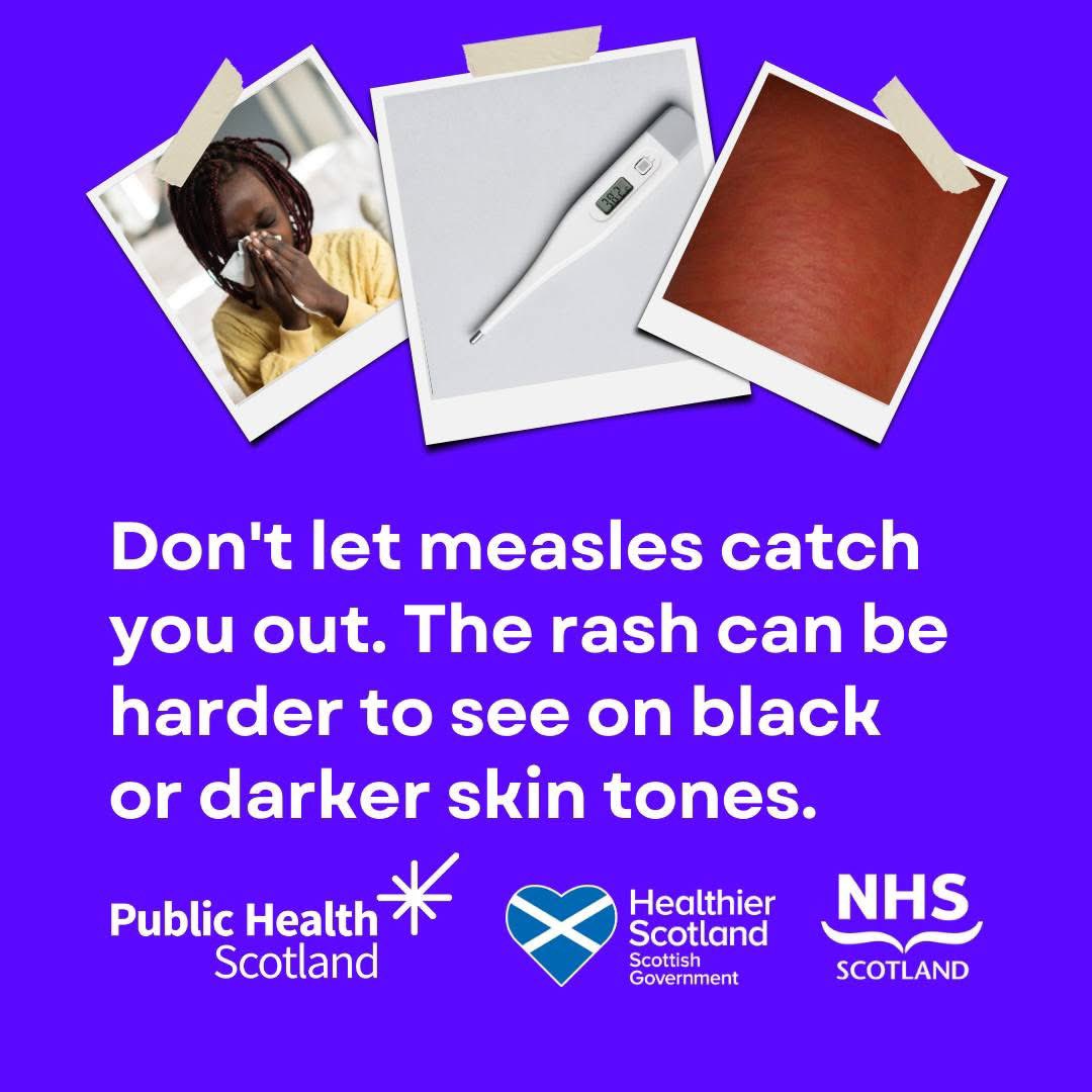 DrNighatArif's tweet image. #MeaslesOutbreak - know the signs!
Itโs a preventable disease
Please get vaccinated.
Vaccines save lives
