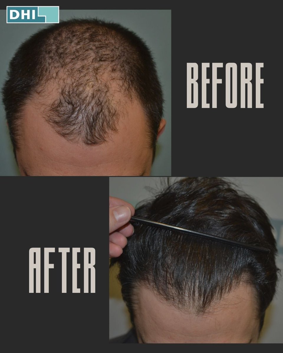 Before &amp; After – The Power of Transformation!

Thanks to the Direct Hair Implantation (DHI) method, natural hair density and style are restored – permanently and scar-free.
💼 100% natural results | 💪 Renewed confidence

#dhi #hairtransplant #hairlosssolution