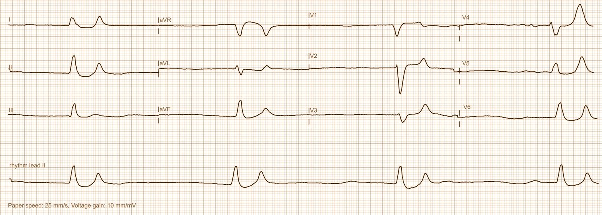 A patient with heart failure under the usual quadruple therapy with increasing deterioration in renal function and this ECG. All clear?