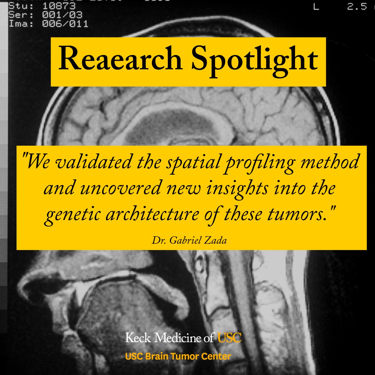 🧠 Why do some brain tumors resist treatment?
New research led by Dr. Gabriel Zada at the USC Brain Tumor Center is helping us get closer to the answer.

In a recent interview with Targeted Oncology, Dr. Zada discusses how his team is using spatial genomics to map the complex