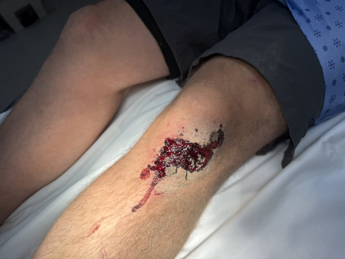 Carbon through axel snapped and threw me off my mountain bike. Helmet saved my head. Nothing broken. Fun hospital visit.