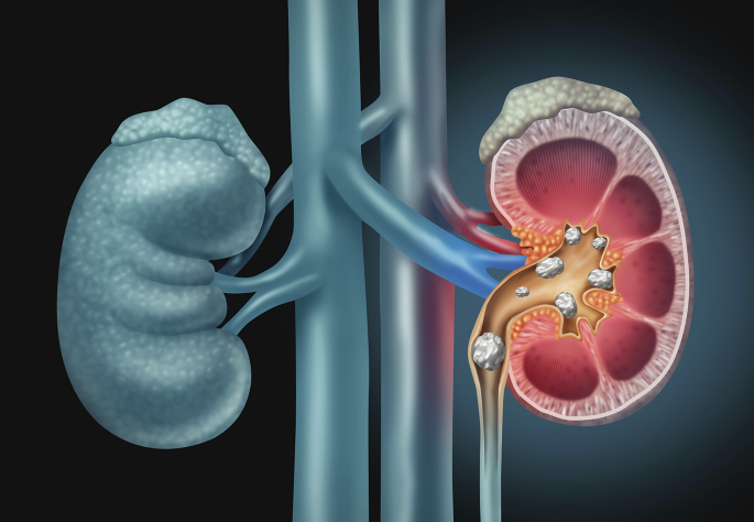 natrevbioeng's tweet image. Boosting precision and confidence in percutaneous nephrolithotomy bit.ly/4lSlRY1
